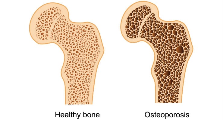 (PDF) HUBUNGAN ANTARA OSTEOARTRITIS GENU DAN FLEKSIBILITAS PADA LANSIA (PDF) HUBUNGAN ANTARA OSTEOARTRITIS GENU DAN FLEKSIBILITAS PADA LANSIA